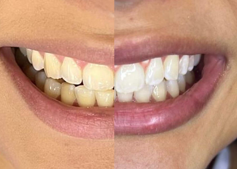 balnqueamiento antes y despues